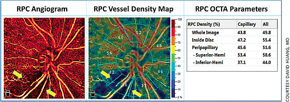 Figure 2. The 4.5 mm x 4.5 mm high-definition (400x400 scans) angiogram of a perimetric glaucomatous eye was quantified by AngioAnalytics. The glaucomatous perfusion defect could be visualized in the RPC angiogram and vessel density map (arrows). The vessel density and capillary density were significantly reduced in the inferior hemisphere, more specifically in the inferior temporal sectors.