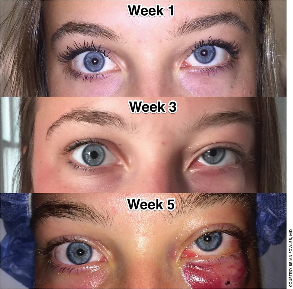 Figure 1. External photos of patient taken at weeks one, three, and five demonstrating progressive left superonasal globe displacement with left lower eyelid edema (Note: Week five photo taken post-sclerotherapy attempt. Photos used with permission.)