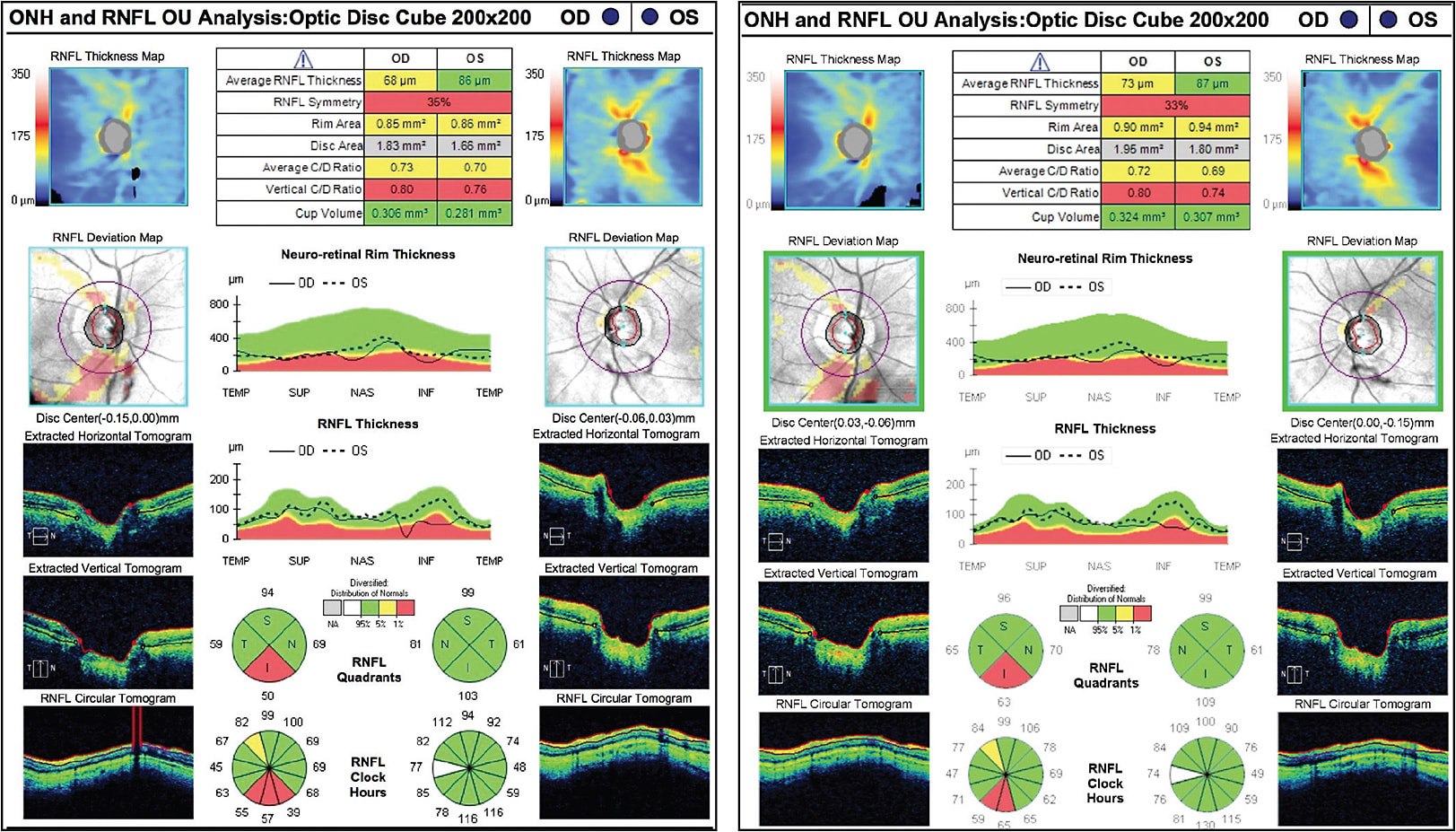 Figure 4. False progression caused by artifact: Patient had apparent progressive thinning of the inferior RNFL progressing to 50 μm on the recent test (left) and 63 μm on the previous test (right). This is attributable to the scan circle superimposed on a vitreous floater, giving a 0-μm measurement in the area visualized on the RNFL thickness TSNIT map and RNFL circular tomogram (Zeiss Cirrus OCT).