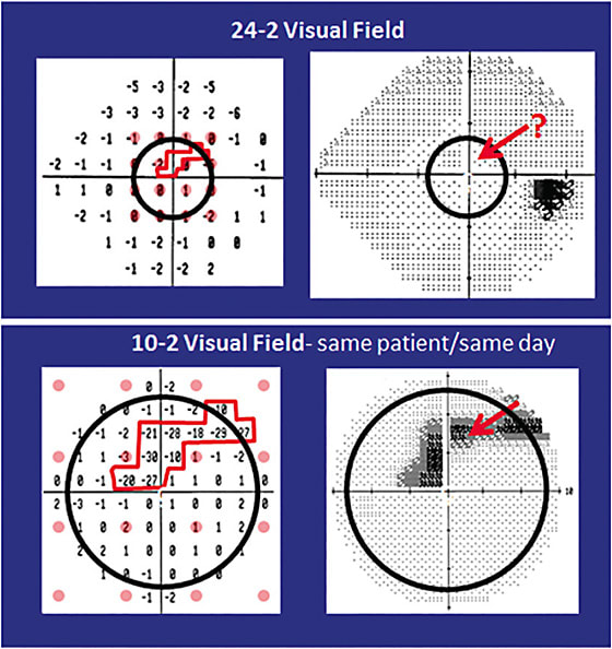 Figure 4. An example of a deep arcuate defect near fixation as seen on the 10-2 visual field (bottom panel), but missed by the 24-2 visual field test (upper panels) obtained on the same day.