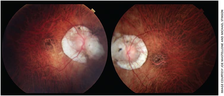Figure 2. Fundus photos of right and left eye, with features consistent with myopic degeneration including 360° of scleral crescent, posterior staphyloma and lacquer cracks. Image taken with a Topcon fundus camera.