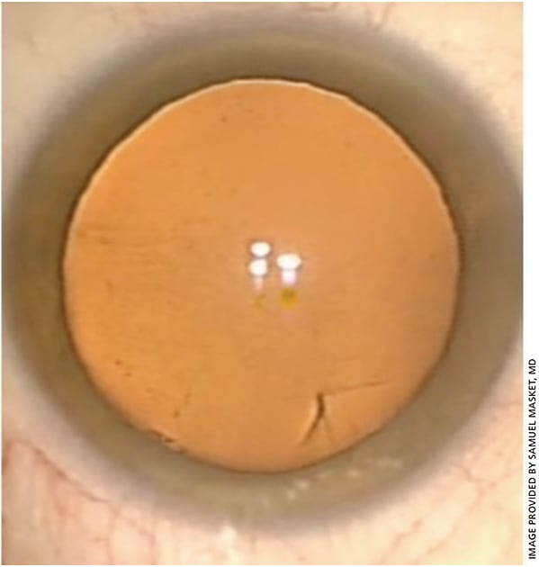 Figure 1a.  Anterior capsule laceration (preoperative).