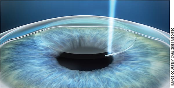 The ReLEx/SMILE procedure requires the VisuMax laser to create a small incision and lenticule inside the cornea ...