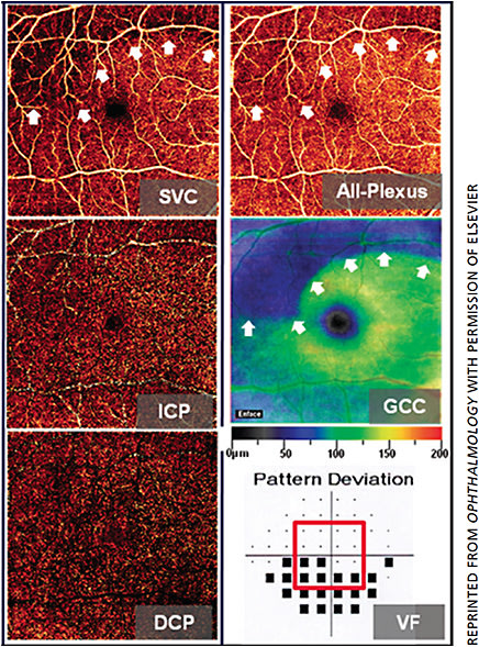 Figure 3. The 6 mm × 6 mm en face angiograms of a perimetric glaucoma eye shown were from projection-resolved optical coherence tomography angiography (PR-OCTA). A superior arcuate defect (arrows) in vessel density appears in the superficial vascular complex (SVC) and all-plexus slabs but not in the intermediate capillary plexus (ICP) and deep capillary plexus (DCP) slabs. These perfusion defects correspond to the superior ganglion cell complex (GCC) thinning and inferior visual field (VF) defect (bottom six black squares within the red outlined area).8