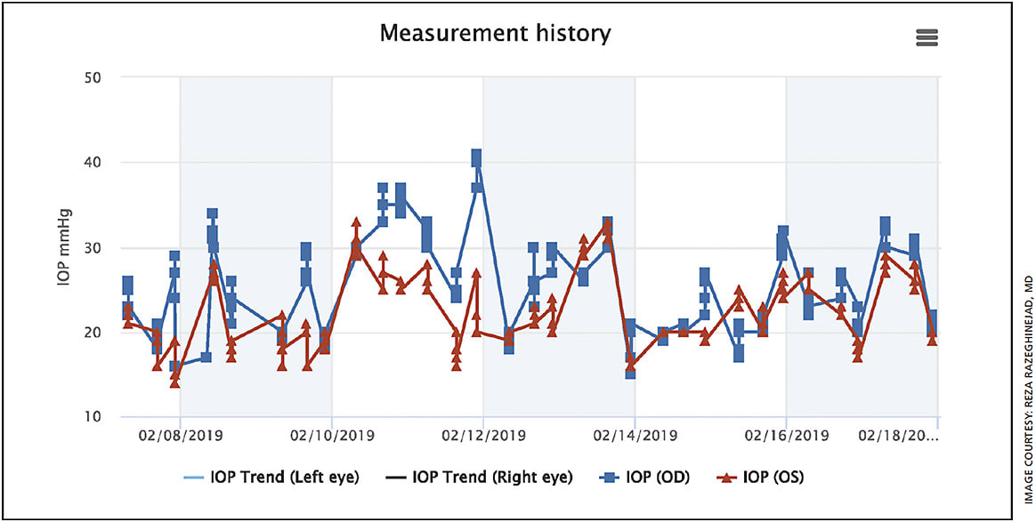 Figure. A print-out of a patient’s measurement history, provided by the iCare HOME tonometer.