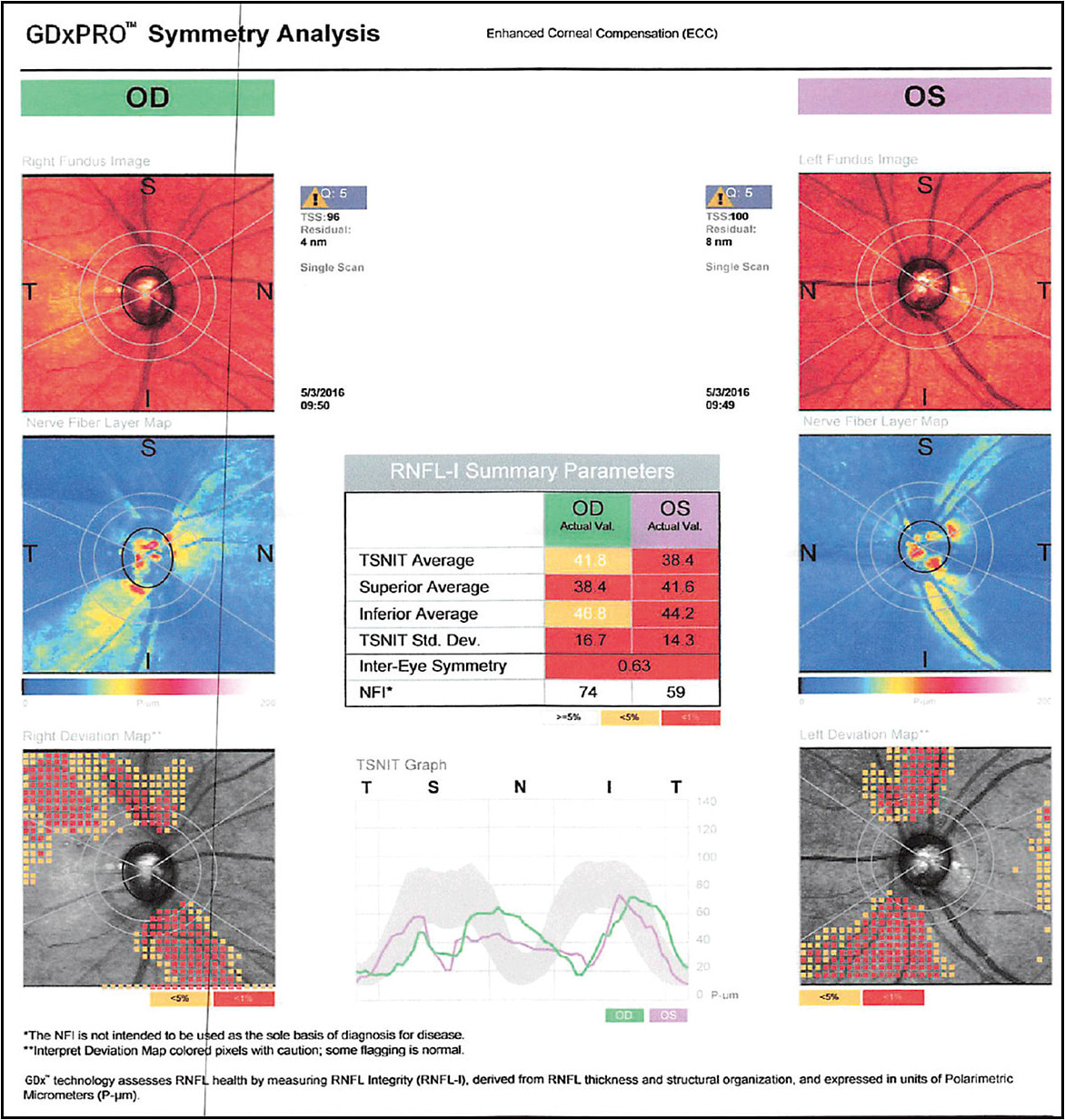 Figure 2. Optic nerve GDx (obtained at a previous visit). Reliable OU with near-diffuse thinning of optic nerve OD and diffuse thinning OS.