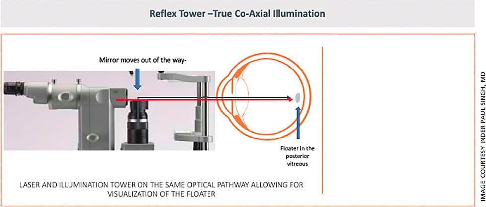Figure 2. Reflex laser tower — the mirror moves out of the way of the laser beam allowing for coaxial illumination. Laser, aiming beam and illumination tower are on the same optical pathway, thus allowing for visualization of the floater in the posterior vitreous.