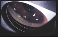 Top: Blood in the sclerostomy site following glaucoma filtering surgery. Bottom: After intracameral tPA injection, the blood resolved. Prior to injection, which was given 9 days post-op, IOP was 26 mmHg. Ten minutes after injection, IOP was 10 mmHg.