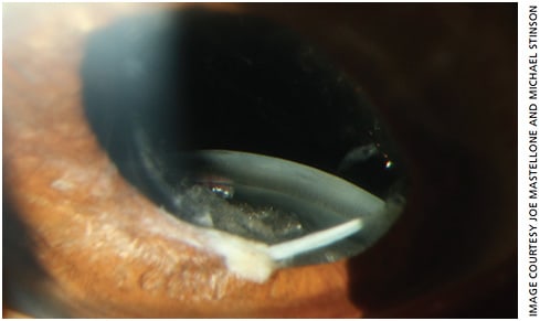 Figure 1. Slit lamp photo of the right eye demonstrating complete inferior dislocation of the posterior chamber IOL. Image taken with the Haag-Streit BX 900 slit lamp