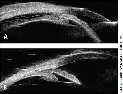 Figure 2: A. UBM showing shallow anterior chamber, anterior rotation of ciliary body with closed angle, and suprachoroidal effusion in the same patient with acute TiACG. B. One week after drug discontinuation, UBM with deep anterior chamber, open angle and resolution of suprachoroidal effusion.