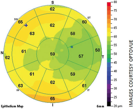 Figure 3. Epi map for a dry eye.