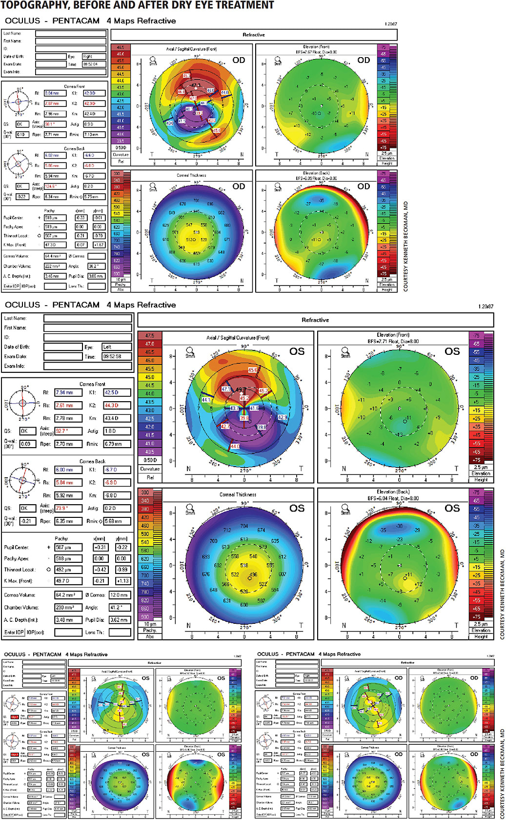 Figure 1. Before: Astigmatism and severe superior conical steepening in both eyes.
After: After dry eye treatment, the cone-like appearance is gone, showing astigmatism alone.