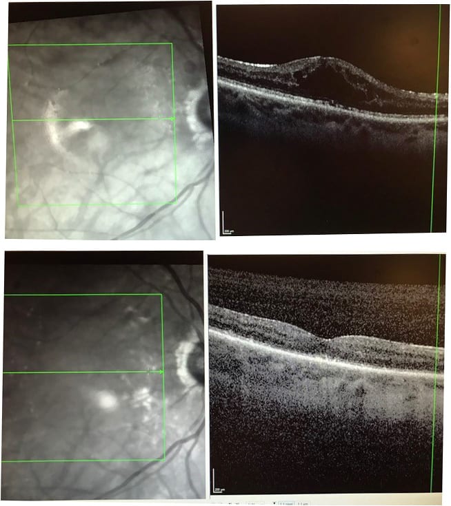 Figure 1. A. CME in patient with silicone oil. B. OCT 10 days after silicone oil removal shows resolution of CME in the same patient.