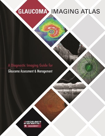 Immediate postop slit-lamp photo of Mrs. Cassady’s eye.