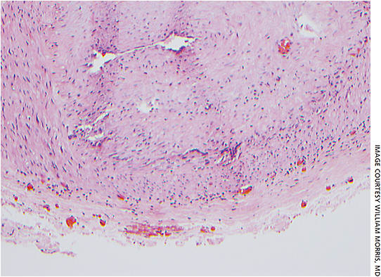 Figure 1. Temporal artery biopsy demonstrating diffuse mononuclear cell infiltrate with giant cells involving the arterial wall intima and media.