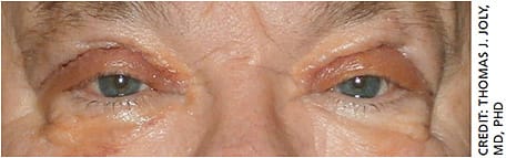 Figure 1. Moderate, nonpathologic inflammation seven days after upper eyelid blepharoplasty.