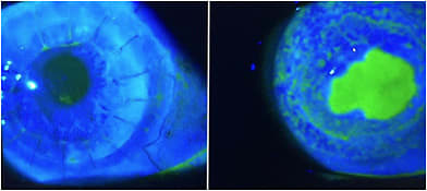 Note the neurotrophic defect.