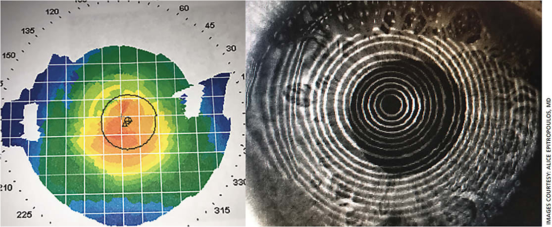 Figure 2. After treatment with Xiidra, the dry eye patient’s cornea became regular and measurements were accurate.