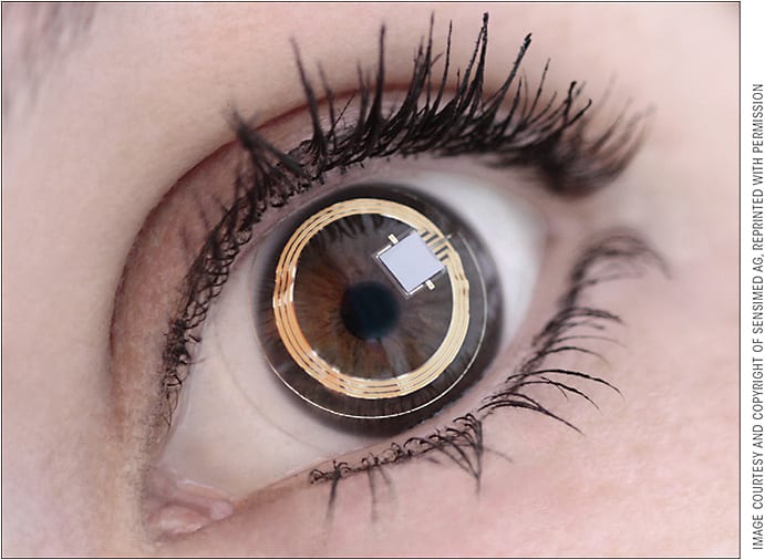 Figure 2. Sensimed Triggerfish contact lens sensor.