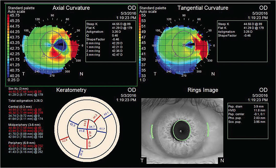 Figure 4. Placido disc corneal topography (Zeiss Atlas) demonstrates irregular astigmatism caused by the pterygium. Note that the rings in the bottom right image are distorted centrally even though the pterygium does not reach the visual axis.