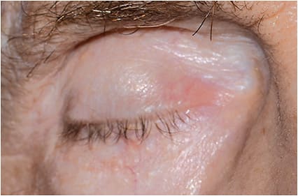 Figure 3: Complete permanent tarsorrhaphy in patient with refractory NK.