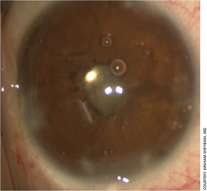 Figure 5. Avoid overtightening the cerclage suture so the pupil size is not too small.