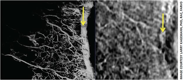 Figure 5. Noninvasive “vascular casting” (right) provides a visualization of the outflow pathway remarkably similar to that produced by a physical neoprene cast (left). The yellow arrows identify Schlemm’s canal.