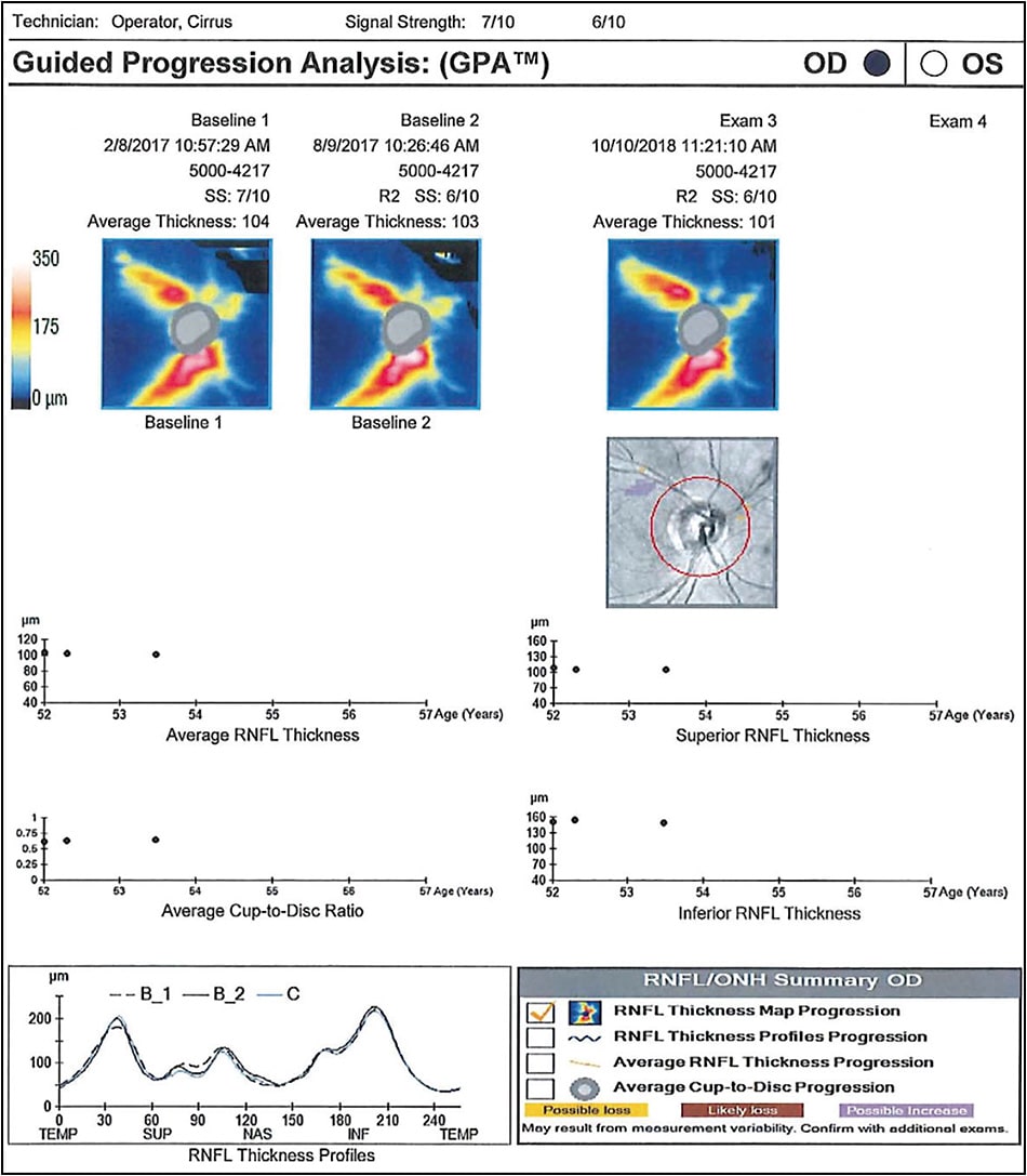 Figure 5. Guided Progression Analysis of OCT RNFL: Most recent exam is compared to two baseline tests in a trend analysis for progression. The inferior RNFL thickness rate of change reaches a statistically significant level and is highlighted on the graph and the RNFL Thickness Profile. The area of change is plotted on the RNFL deviation map (Zeiss Cirrus OCT).