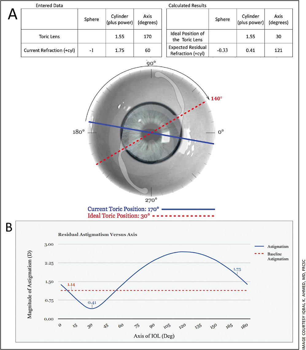 Figure 1. (A) Output from the Toric Results Analyzer. IOL power and lens axis, along with manifest refraction, were inputted into the analyzer. The formula calculated that the ideal position of the IOL should be at 30 degrees, which would result in a residual refraction of -0.33 sph/0.41 cyl x 121. (B) The effect of IOL axis on the magnitude of astigmatism with the 23.0 D Acrysof IQ Toric SN60AT IOL. The lowest magnitude of astigmatism is achieved with the IOL placed at 30 degrees.