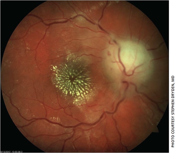 Figure 3. Fundus photo OD showing swollen optic nerve head and a macular star.