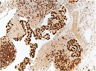 Figure 5. Pathology on an inguinal lymph biopsy was consistent with metastatic carcinoma with clear cell features of gynecological origin.