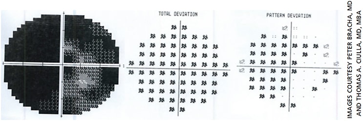 Figure 1. Humphrey 10-2 central threshold visual field of the patient’s right eye: The test was reliable based on false-positive, false-negative and fixation loss criteria. The mean deviation was -30.44 DB. A dense, generalized depression can be seen with a small island of remaining vision.