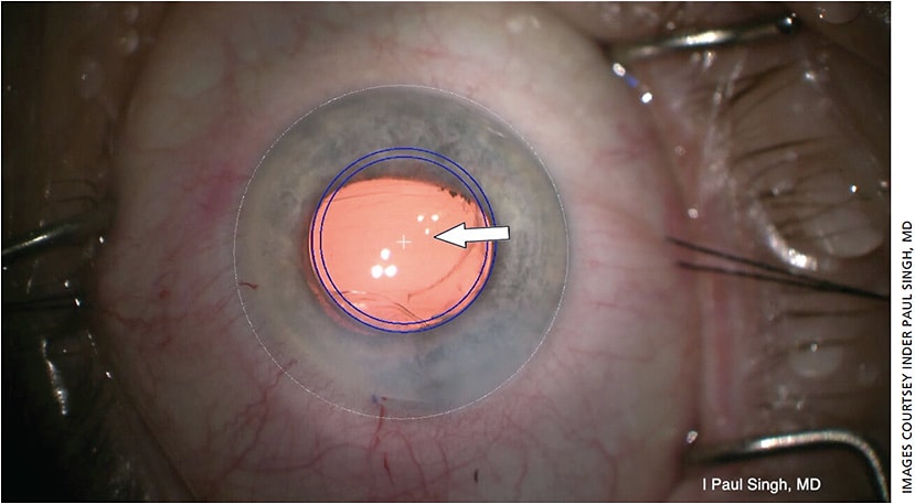 A three-piece multifocal IOL is placed in the sulcus of an irregular pupil, with the Zeiss Callisto eye system indicating the center of the visual axis.