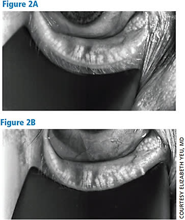 Infrared meibography images taken 6 months apart, immediately before and after LipiFlow thermal pulsation therapy. The disorganized area of acini and truncation demonstrates greater population and some lengthening in same area 6 months later. This begs the question of whether or not meibomian gland could be reversed if caught early enough.