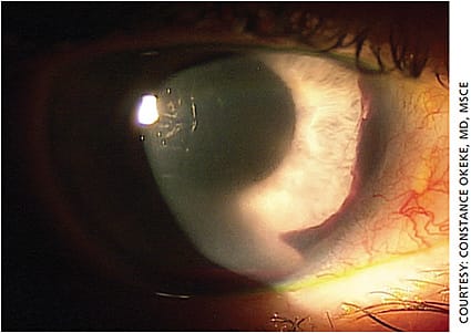Figure 1. Postoperative inflammation and bleeding after a MIGS procedure can threaten the overall outcome if not well controlled.