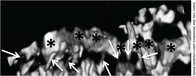 Figure 4. This virtual casting of a living human cast of Schlemm’s canal (the author’s) reveals a nodular and irregular structure. The arrows identify collector channels protruding from the canal into the surrounding vascular network.12