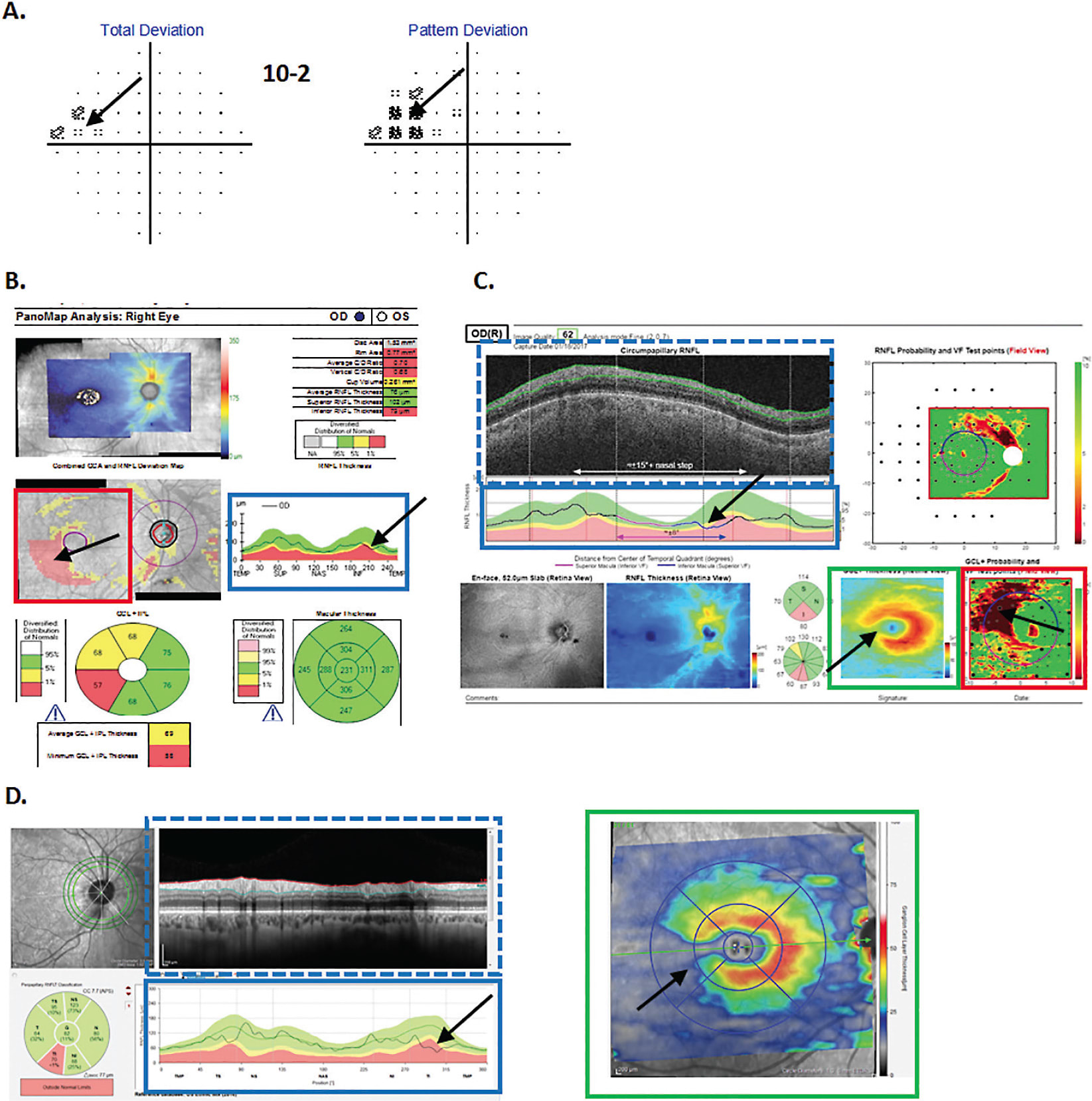 Figure 5. A. 10-2 visual field for a patient with an arcuate defect in the macula. B. Zeiss OCT report based on cube scans of both the macular and disc. C. Topcon OCT report based upon a wide-field scan including both the disc and macula. D. Heidelberg reports from a circle scan of the disc (left) and a cube scan of the macula. For panels B-D, the blue rectangle indicates the circumpapillary retinal nerve fiber thickness plot; the blue dashed rectangle the circumpapillary scan image; the green rectangle the ganglion cell (GC) thickness map (D, right) or GC+ inner plexiform map (C); and the red rectangle the GC+IPL probability/deviation map (B, C). The black arrows indicate corresponding regions of damage.