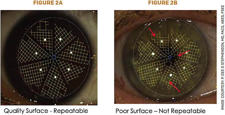 FIGURE 2. Cassini surface qualifier honeycomb patterns using a Cassini topographer. When the pattern looks like a honeycomb (2A) and is not missing any sides to the pattern (such as where the arrows are pointing in 2B), then it is a repeatable pattern. The surface of the cornea is then in great shape to proceed with surgery.
