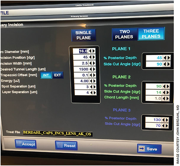 Depicted are the clinical settings Dr. Berdahl uses to make corneal incisions with his LenSx laser. These settings are not translatable from laser to laser.