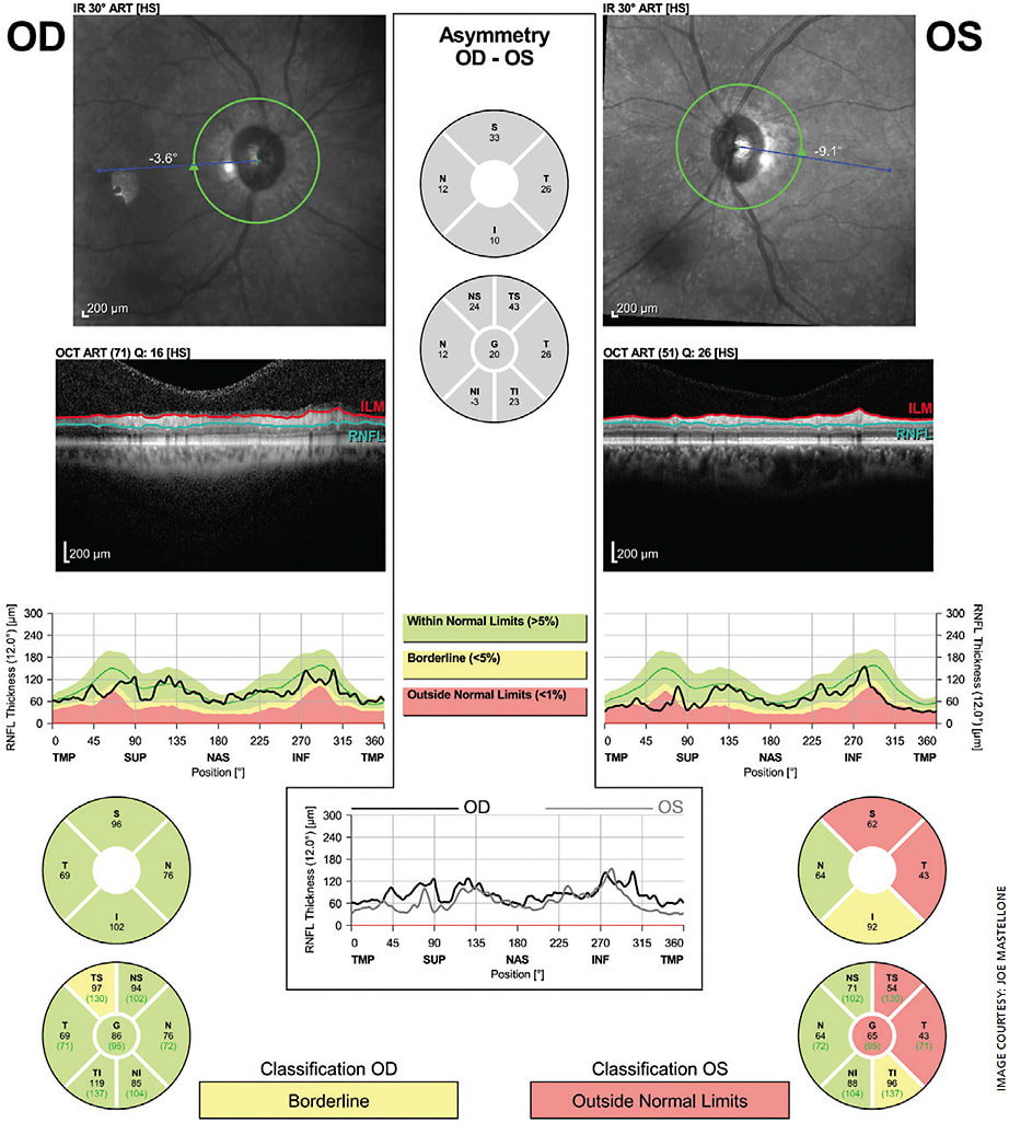 Figure 1. Spectral domain OCT of the optic nerve OU showing overall intact nerve fiber layer OD with thinning OS