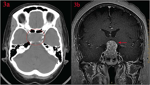 Figure 3. CT head without contrast (A) and MRI brain (B) demonstrate a large mass in the sellar region extending to the level of the optic nerves and optic chiasm (red arrow).