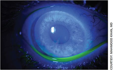 This is a 27-year-old female with a history of intravitreal injections who presented with diffuse epitheliopathy secondary to ocular surface disease.