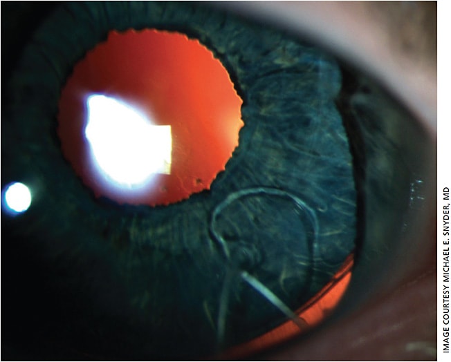 Figure 3. Retroillumination image of custom, flexible iris and Cionni ring in the bag.