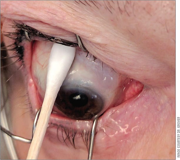 Figure 4. Preoperative photograph demonstrating the bolus of MMC being rolled into the superior nasal quadrant prior to performing the Xen surgery.