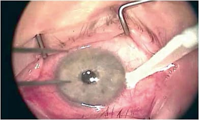 Superficial keratectomy is a simple treatment for Salzman nodules.