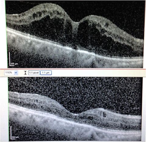 Figure 2. Pseudophakic CME showing resolution of edema four weeks after difluprednate 0.05% and ketorolac tromethamine 0.4% eye drops q.i.d.