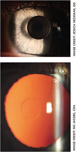 As part of our presbyopia issue, we highlight both the Kamra (top) and Raindrop (bottom) corneal inlays.