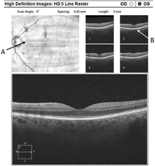 Figure 12. Above: Arrow A: most of the opacity has been removed with the laser. Arrow B demonstrates the shadow now gone on the 5- line raster scan.