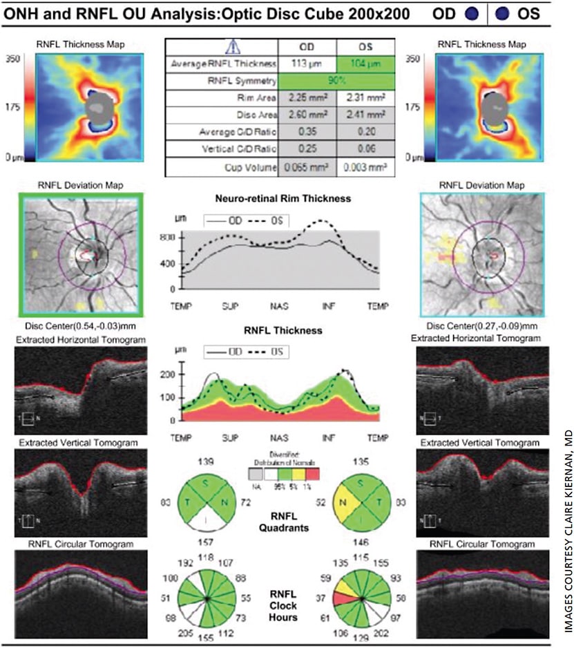 Figure 2. Cirrus HD-OCT RNFL and ONH OU demonstrating overall intact nerve fiber layer without significant thinning.