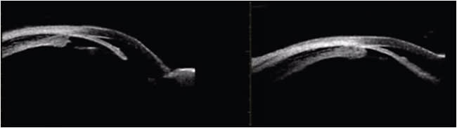 Figure 1. UBM images demonstrating an edematous ciliary body (left) and forward-shifting iris-lens complex with resultant narrow angle (right).